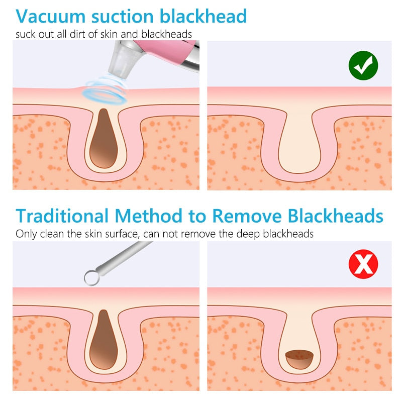 Facial Blackhead Remover Electric Acne Cleaner Device